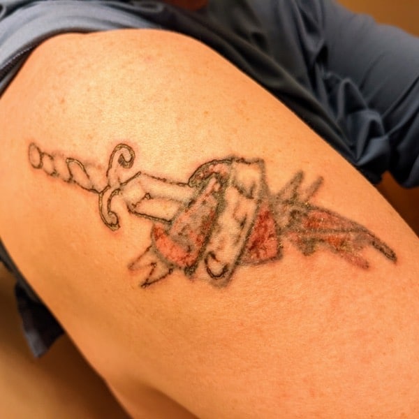 Cp tattooremoval 1